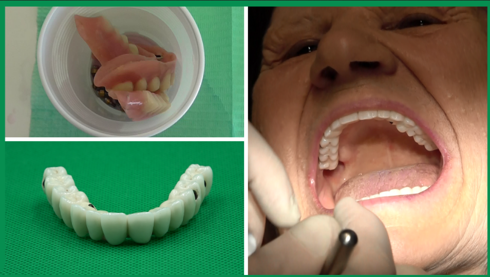 Osso alveolare o osso basale? Il motivo per cui ti dicono che “non hai osso” (e come puoi evitarlo)