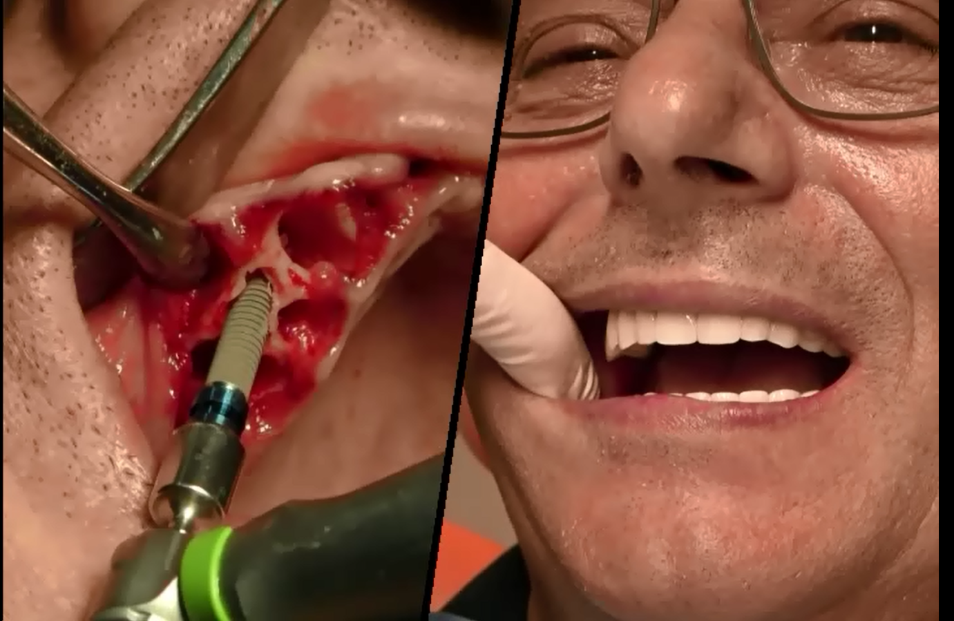Osso alveolare vs osso basale: il vero segreto per mettere i denti fissi quando ti dicono che “non hai osso”