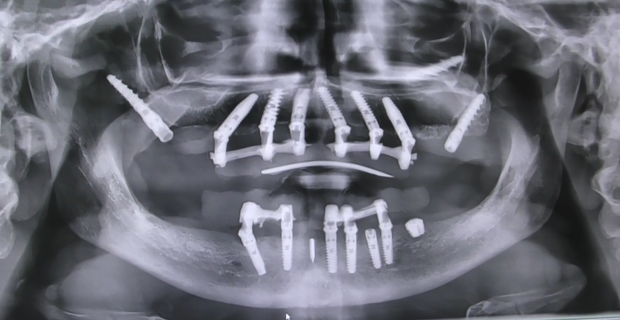 PANORAMICA DI TECNICA DELLA BILATERAL SINUS SOLUTION